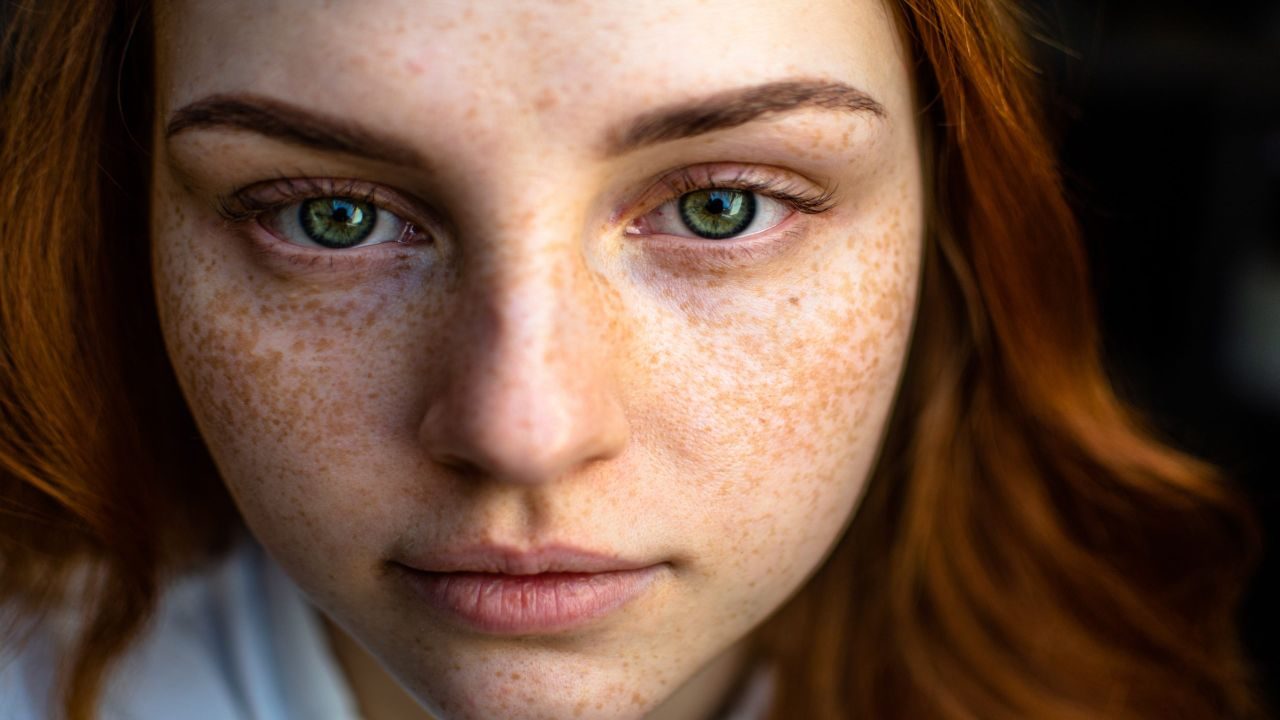 Sun Damage and Hyperpigmentation